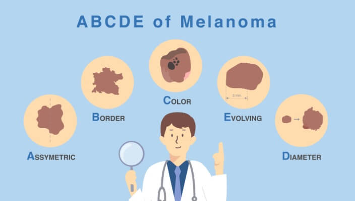 melanoma-abcdes